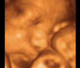 3D Ultrasound Images