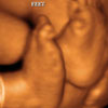 4D Ultrasound Image